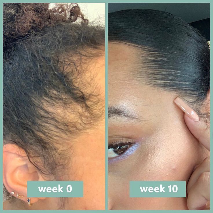 Minoxidil Hair growth Solution™